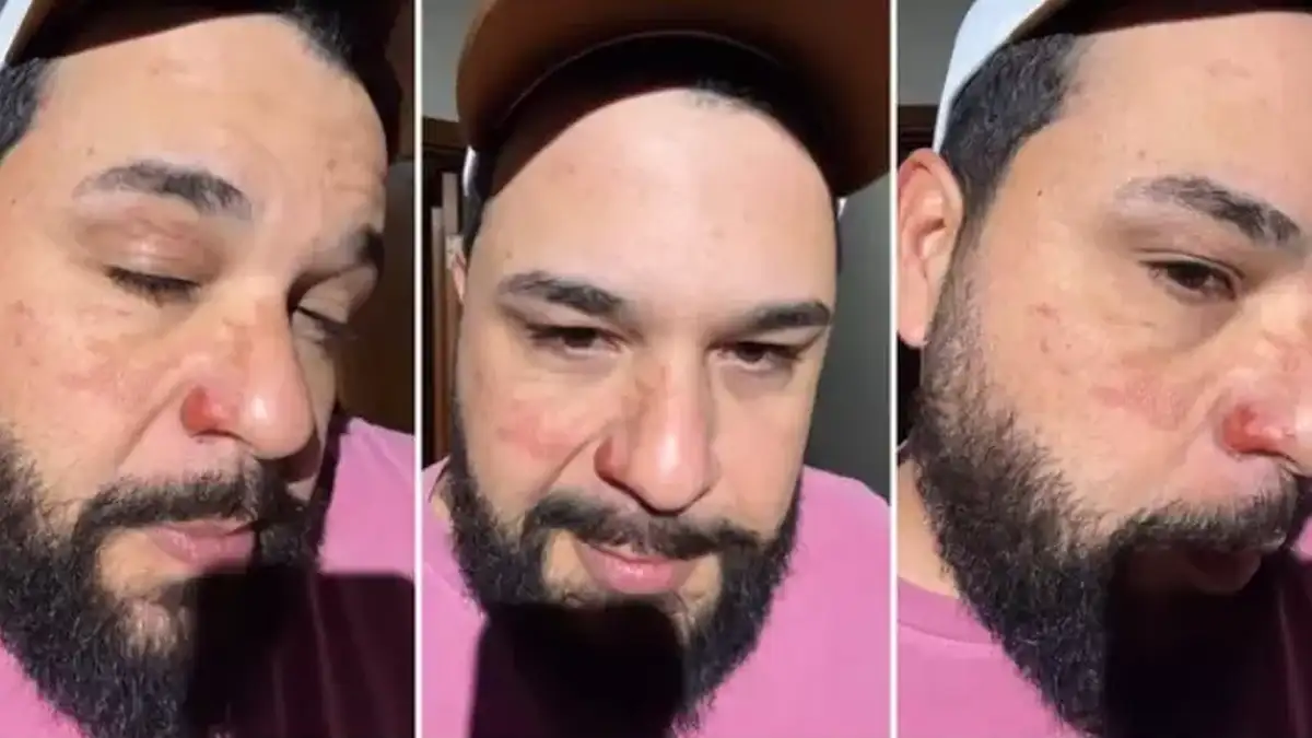 “Gritei de dor”: Cantor sertanejo Léo tem rosto queimado por chamas no palco e cicatrizes chocam fãs